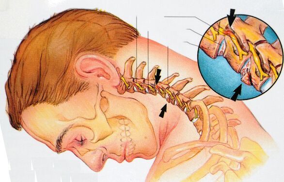 ساختار مهره های دهانه رحم