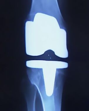X -ray تصویر زانو با پروتز مصنوعی پس از عمل برای تغییر مفصل